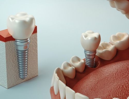 Todo lo que necesitas saber sobre la intervención de implantes dentales