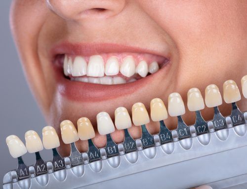 ¿Cómo pueden ayudarte las carillas dentales?