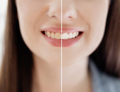 Manchas en el esmalte dental: ¿cómo solucionarlas?
